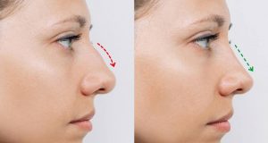 Rhinoplasty Recovery